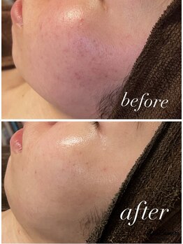 雅菜(miyabina)/憎き　肌荒れ跡さようなら～