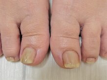 マハロ(MAHALO)/巻き爪ケア