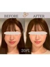 チョコバリ 中目黒店(chocobari)/小顔×リフトアップ(美容鍼)20代