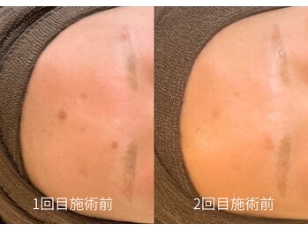 エミルカ 日の出平井店(EMILUCA)/おでこニキビ後のシミも綺麗に♪