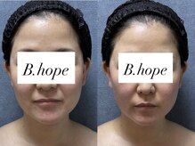 ビーホープ(B.hope)/30代モニター様3回目