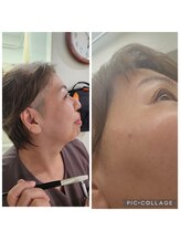 ミホズルーム(Miho‘s room)/ピーリングの Before →After