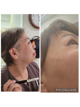ミホズルーム(Miho‘s room)/ピーリングの Before →After