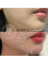 チップ(chip)/剥離は個人差があります