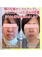 ナゴミ(NAGOMI)/リフトアップ力抜群の小顔矯正