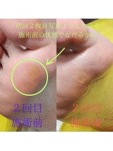 ドクターネイル爪革命 長野店/【たこ・うおのめ】リラク/足裏