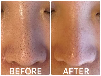 ハーブピーリング 恵比寿/小鼻毛穴