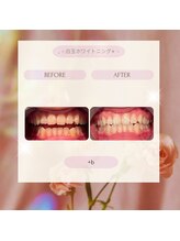 プラスビーセルフ(+b self)/ホワイトニングビフォーアフター