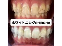 シロハ(SHIROHA)/セルフホワイトニング/天王寺