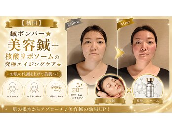 ラ コンシェル たまプラーザ店の写真/【キュッとリフトアップしたいなら美容鍼♪】お顔のたるみ/ほうれい線/もたつきは,話題の美容鍼で改善◎