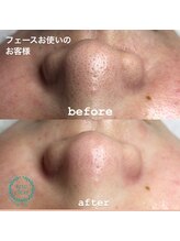 ビューティーネイル(Beauty Nail)/毛穴エクストラクション