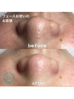 ビューティーネイル(Beauty Nail)/毛穴エクストラクション