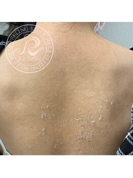 チップ(chip)/BODY(背中)