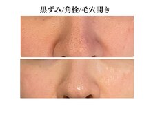 リノ(Lino)/毛穴の悩みにアプローチ