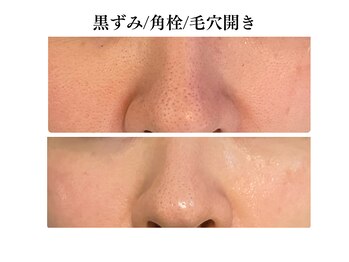 リノ(Lino)/毛穴の悩みにアプローチ