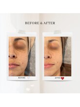 エクラ アン(eclat.un)/４０代女性：毛穴スペシャル