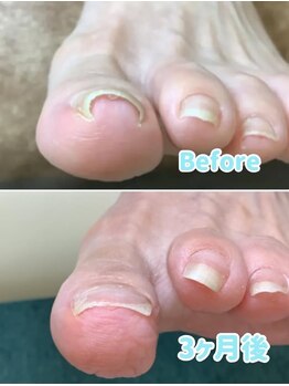 リゼラアンドコー 布施店/巻き爪ケア