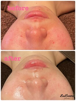 雅菜(miyabina)/赤み軽減！透明感のある美肌へ