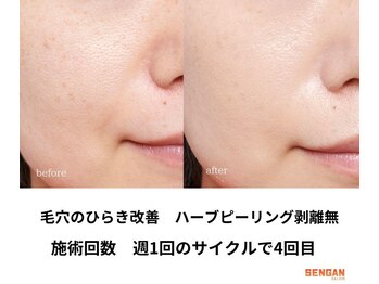 センガン(SENGAN)/ハーブピーリング 剥離無