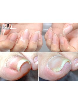 爪の悩みを解消できる（ケア含む）