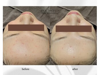 アン ビューティー(ann beauty)/施術1回【症例写真】30代