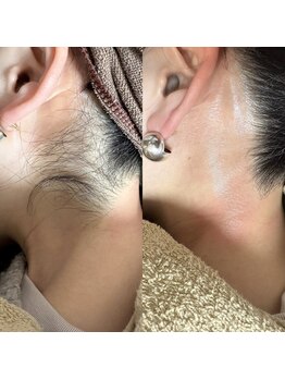 ルピナス(Lupinus)/うなじwax脱毛