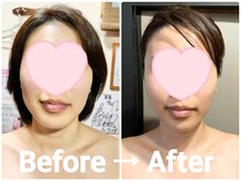 リコメンス(Recommence)/-8歳の若見えは４回で手に入る