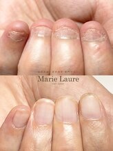 マリーロール 梅田店(Marie Laure)/自爪育成/深爪矯正/ネイルケア