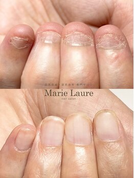 マリーロール 梅田店(Marie Laure)/自爪育成/深爪矯正/ネイルケア