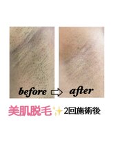 ステラ(Stella)/脱毛効果抜群で安心♪