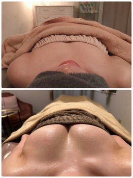 リール 新宿店(RIRE)/40代前半 バストアップ症例