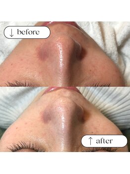 トータルビューティーサロンリア(Li'a)/ビフォー＆アフター