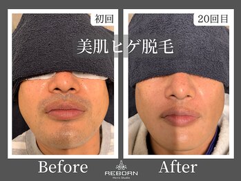 メンズスタジオ リボーン(REBORN)/顔脱毛/ひげ脱毛/松山