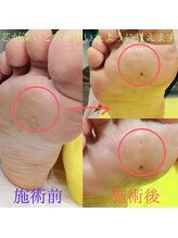 ドクターネイル爪革命 長野店/【たこ・うおのめ】リラク/足裏