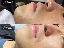 ココモンド(COCOMONDO)/顔脱毛/ヒゲ脱毛/メンズ脱毛