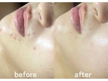 ホワイトアクア 鹿児島店(WHITE AQUA)/ハーブピーリング/肌質改善