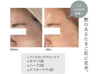 ミミルーチェ(mimiluce)/オトナ肌質改善プログラム
