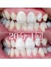 【初回限定】セルフホワイトニング　20分 1回　3300円