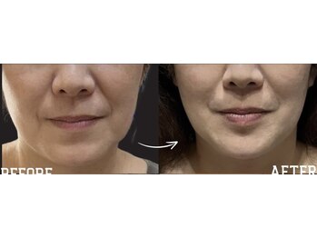 ルキア(LUKIA)/小顔【初回お試し】　施術１回