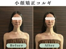 スイスパ 恵比寿(翠SUI SPA)/【小顔矯正コルギ】Before/After