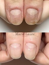 マリーロール 梅田店(Marie Laure)/自爪育成/深爪矯正/ネイルケア