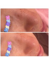 サロンジー(Salon Gee)/いちご鼻脱出！！！！