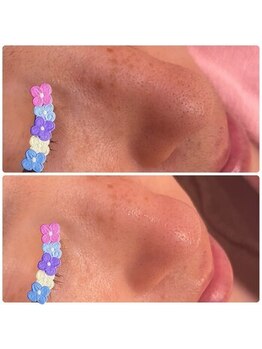 サロンジー(Salon Gee)/いちご鼻脱出!!!!