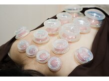 たたら鍼灸整骨院/カッピング