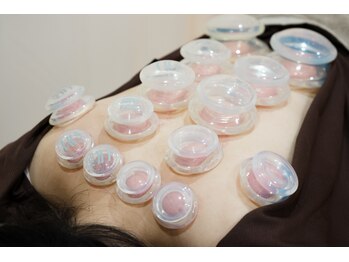 たたら鍼灸整骨院/カッピング