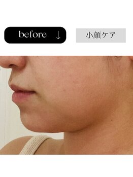 アイチューズ(ICHOOSE)/技術力が自慢の小顔リフトケア