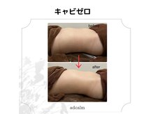 アドカーム(adcalm)の雰囲気（キャビゼロの変化）