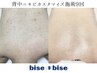 背中ニキビ背中ニキビ跡改善［ハイドラ洗浄×アクネフォト×ビタミンC導入］