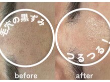 ホワイトアクア 鹿児島店(WHITE AQUA)/ララピール/肌質改善/毛穴洗浄