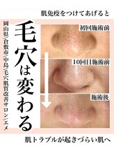 エメ(Aimer)/毛穴黒ずみ